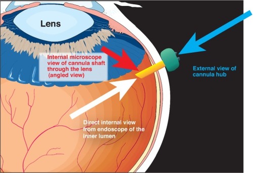 Figure 4 Experimental setup for evaluating vitreous incarceration in rabbit and porcine cadaver eyes.