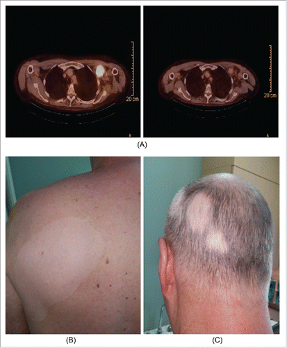 Figure 3. Example of CR due to concurrent radioimmunotherapy associated with acquisition of vitiligo. Radioimmunotherapy: This shows results of radioimmunotherapy in a 62 y old man with locally advanced, BRAF mutation negative melanoma of unknown primary involving bulky left axillary, left supraclavicular and left subpectoral lymph nodes with impingement of neurovascular structures in left axilla and invasion of adjacent chest wall. He was treated with 4 cycles of ipilimumab with concurrent conventional radiotherapy (48 Gy in 20 fractions) to the left axillary mass. He sustained radiographic complete response in all sites of disease and subsequently had a completion left axillary lymph node dissection in region of prior bulk and had no evidence of remaining melanoma consistent with a pathologic complete response. He has remained well since then.
