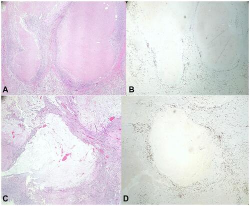 Figure 2 Pancreas with treatment effect. H&E stain (A and C) shows areas of necrosis surrounded by lymphocytes consistent with prior tumor bed. CD3 immunohistochemical stain (B and D) highlights CD3+ T lymphocytes surrounding areas of prior tumor bed.