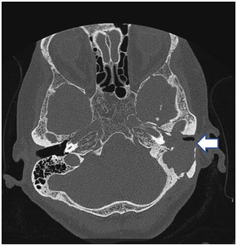 Figure 1. HRCT (bone window) of the temporal bone performed before the surgery shows erosion of the mastoid cavity and ossicles (arrow).