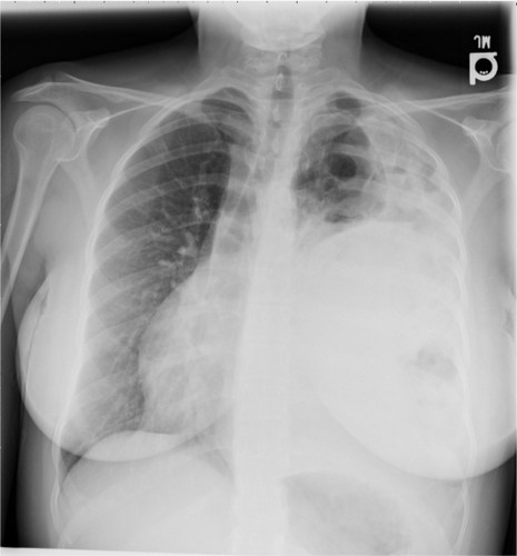 Figure 1 Cystic appearance to left lung with elevated hemidiaphragm.