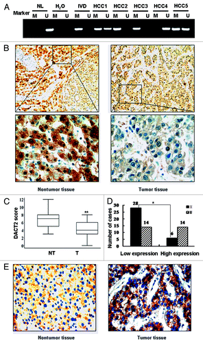 Figure 2.DACT2 expression is associated with promoter hypermethylation in primary HCCs. (A) Representative MSP results of DACT2 in primary HCCs. (B) DACT2 expression in a representative HCC case. Left image: adjacent non-tumor tissue (100×) and the indicated fields enlarged (400×). Right image: tumor tissue (100×) and the indicated fields enlarged (400×). (C) DACT2 expression scores are shown as box plots, the horizontal lines represent the median score; the bottom and top of the boxes represent the 25th and 75th percentiles, respectively; the vertical bars represent the range of data. Expression of DACT2 was different between non-tumor tissues and tumor tissues in 62 matched primary HCCs. **p < 0.01. (D) The correlation of DACT2 hypermethylation and expression level were analyzed in 62 matched primary HCCs. *p < 0.05. (E) β-catenin expression in the representative methylated case (400×). β-catenin expression is positive mostly in the membranes of hepatic cells (left image) and in the cytoplasm and nucleus in tumor cells (right image).