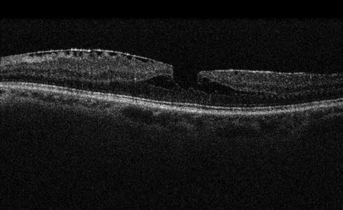 Figure 1 Optical coherence tomography of a tractional lamellar macular hole, characterized by epiretinal membrane with surface wrinkling, sharp intraretinal split, and “schisis-like” appearance.