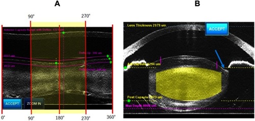 Figure 6 Image of circle scan (A) and line scan (B) in the left eye. The circle scan indicated zonular dehiscence from 90° to 270° (yellow shadow area). The line scan showed the largest area of zonular dehiscence was 180° (blue arrow).