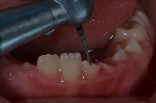 Figure 4 Circumferential enamel bevel placed on both fractured teeth.