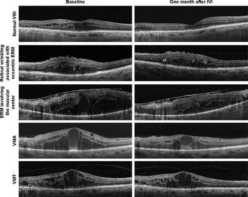 Figure 1 Representative examples of cross-sectional optical coherence tomography scans from eyes with diabetic macular edema with a normal vitreoretinal interface and various vitreoretinal interface abnormalities.