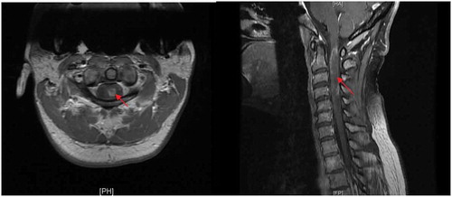 Image 1,2. MRI cervical spine with contrast. Arrow shows contrast enhancement of thickened region of cervical cord from cervicocranial junction to C5-6