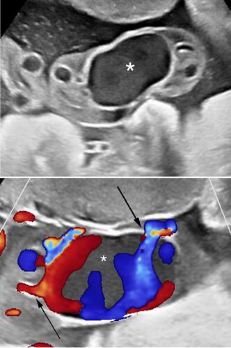Figure 6 Upper panel: Real-time sonography depicting echogenic mass (*)within the umbilical vein, considered consistent with umbilical vein thrombosis. Lower panel: Color Doppler sonography depicting echogenic mass within the umbilical vein, considered consistent with umbilical vein thrombosis. Black arrows point to the narrow venous inflow and outflow areas, respectively.