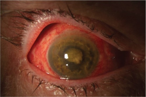 Figure 1 Anterior segment photograph of a patient with endophthalmitis following pars plana vitrectomy operated for rhegmatogenous retinal detachment. Cultures were positive for Bacillus cereus. Visual acuity was light perception after treatment.