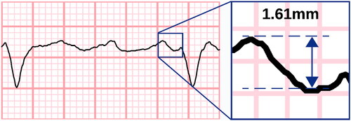 Figure 2. Measuring the fibrillatory wave amplitude. Fibrillatory waves were measured at the oscillating baseline not including QT intervals. Here, measurement was made from peak to trough; however, a trough-to-peak method was also accepted if it provided higher amplitudes. Electrocardiogram line thickness was set at 0.15mm. A coarse fibrillatory wave is presented with maximum amplitude of 1.61mm (measured with electronic callipers for demonstrative purposes). Measurements were rounded down to nearest 0.25mm. ECG with 50 mm/s recording speed and 10 mm/mV voltage gain.