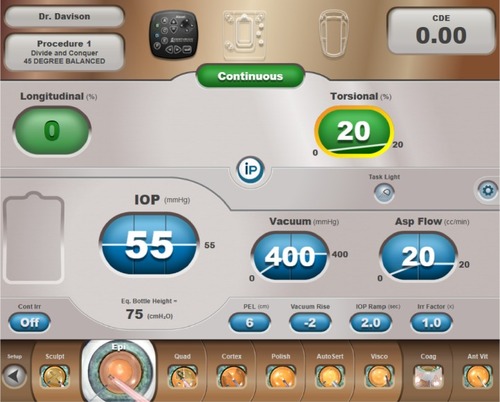 Figure 4 The machine panel display of the Epinucleus Removal Setting (Epinucleus Removal Step Button enlarged in the procedure step toolbar) shows linear control of vacuum and aspiration flow in foot position 2, which becomes fixed at their maximums in foot position 3 when linear control of continuous torsional amplitude becomes available. The iP feature is engaged but does not come into play in soft cataracts. The Epinucleus Removal Setting procedure step button is between the Sculpt and Quadrant Removal procedure step buttons in the procedure step toolbar along the bottom of the display.