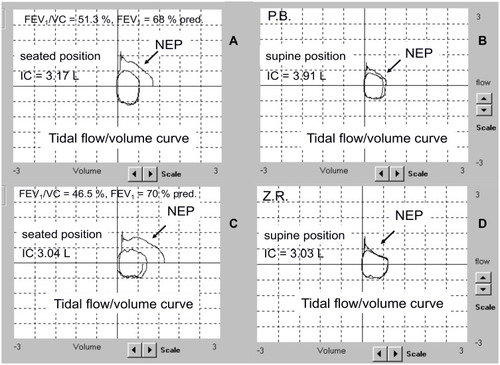 Figure 1 A representative COPD patient reporting no dyspnea and orthopnea during night-time and dyspnea at early morning (two days in the past week – no rescue drugs). Note the absence of supine EFL during tidal expiration assessed by the NEP method and an increase of supine IC of 730 mL (upper panels A and B). A representative COPD patient reporting dyspnea and orthopnea during night-time and dyspnea at early morning (all days in the past week – rescue drugs on two occasions). Note the presence of supine EFL during tidal expiration assessed by the NEP method and no change in supine IC (lower panels C and D).