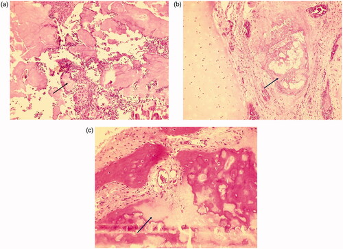 Figure 5. (a and b) Bone biopsy revealed the presence of urate crystals (hematoxylin and eosin staining, ×100 original magnification) and (c) demineralization (hematoxylin and eosin staining, ×100 original magnification).