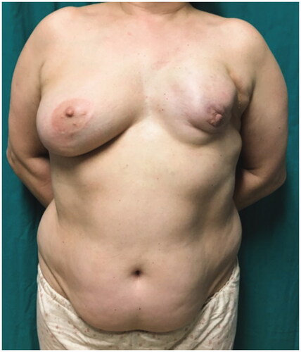 Figure 1. Preoperative photograph showing left breast deformity.