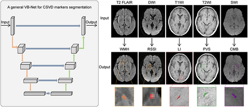 Figure 1 A general 2D VB-Net used for segmenting multiple cerebral small vessel disease (CSVD) markers. The VB-Net included an encoder-decoder framework for feature embedding, residual connections for information flow, and bottleneck layers for model compression. The VB-Net automatically segmented five CSVD markers on the corresponding MRI sequence. Specifically, T2-fluid attenuation inversion recovery (T2-FLAIR), diffusion-weighted imaging (DWI), T1-weighted magnetic resonance imaging (T1WI), T2-weighted magnetic resonance imaging (T2WI), and susceptibility-weighted imaging (SWI) were used to segment the white matter hyperintensity (WMH), recent small subcortical brain infarction (RSSI), lacunar infarction (LI), perivascular spaces (PVS), and cerebral microbleeds (CMB), respectively.