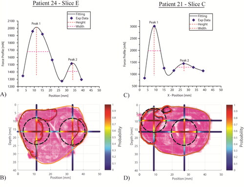 Figure 9. Two example histology slices with associated measured and fitted force profiles, and outlines of prostate and PCa nodules. A probability threshold of 0.5 was used to obtain the predicted PCa nodules (in black).