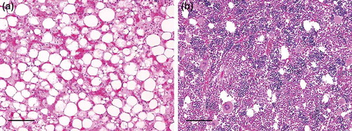 Figure 1. Histological findings from femoral bone marrow from: (a) a field case of BNP euthanized at approximately 3 weeks old, showing almost total loss of hematopoietic cells and their replacement by erythrocytes and proteinaceous fluid and (b) an unaffected healthy calf, showing normal high cellularity with little fatty stromal tissue apparent. Haematoxylin and Eosin. Bars = 100 µm. (reproduced with permission from BMJ Publishing Group Limited. Idiopathic bovine neonatal pancytopenia in a Scottish beef herd [Citation2]).