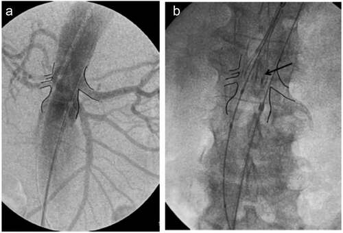 Figure 4. (a). Intraoperative angiography of an aneurysm to mark the orifice of the renal arteries. (b). In order to achieve very precise sealing at 7 mm infrarenally, it is advisable to begin deployment with the proximal markers (arrow) of the top end of the graft aggressively at the level of the renal arteries – or even more centrally- in order to counterbalance an anticipated small caudal migration upon completion of the deployment (image courtesy of Dr. Georgiadis).