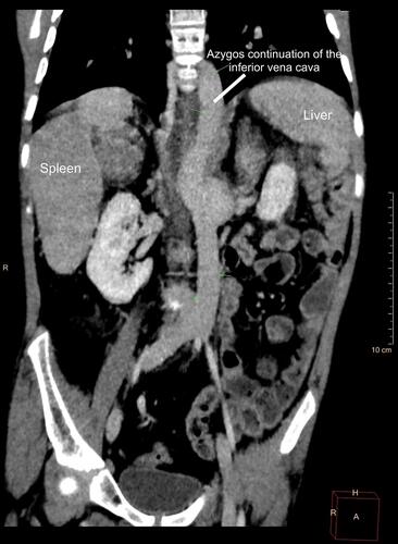 Figure 2 Coronal image of the computed tomography scan demonstrating situs inversus and the absence of the hepatic segment of the inferior vena cava with azygos continuation.