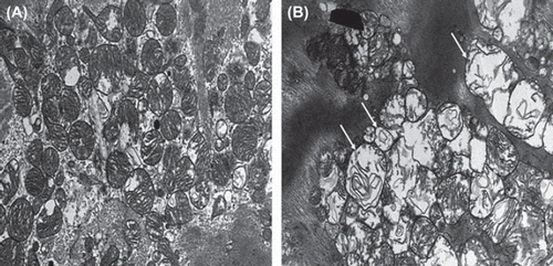 Figure 1. Representative electron microscopy of right atrium before (A) and during (B) coronary artery bypass grafting (CABG). Note injured and swollen mitochondria indicating ischemia and edema shown with arrows in B.