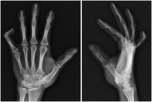 Figure 1. Plain radiographs of the left hand of a 39-year-old male of Amish descent with congenital proximal symphalangism demonstrating bony fusion of the second through fourth PIP joints and camptoclinodactyly of the fifth DIP joint.