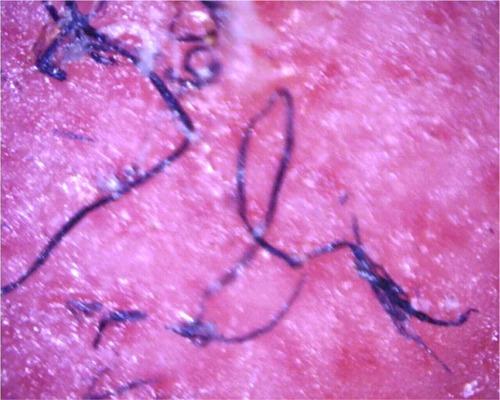 Figure 3 Filaments remaining embedded in deeper layers of skin after removal of a callus; magnification 100×.