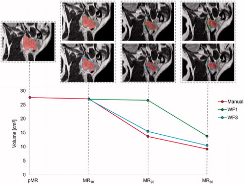 Figure 3. One patient who experienced large relative shrinkage of the GTV-N over the treatment course, as shown by the red curve for manual delineation. The DIR propagated GTV-N from pMR to each session scan in WF1 (green) remains fairly constant in volume compared to the GTV-N propagated from the previous MR, with corrected structures of WF3 (blue), follows the shrinking tumour size better.