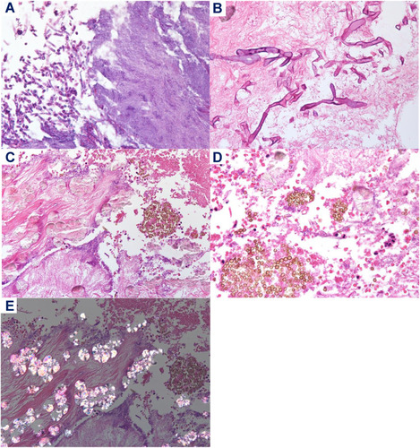 Figure 4 Histopathological findings. (A) Infiltrations of Candida species and Actinomycetes in the background of necrotic tissue of the soft palate (hematoxylin and eosin (HE) staining, × 600). (B) Infiltration of Mucor in the background of necrotic tissue of the soft palate (HE, ×400). (C–E) Low- (×100) (C) and high- (×400) (D) power magnification views of resected gangrene. Brown spores of Aspergillus niger and surrounding calcium oxalate crystals were identified in the background of necrotic tissue (E).