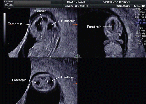 Figure 14.  Three orthogonal image of normal brain at the end of 8 weeks of gestation. The development of premature ventricular system is seen. Note the different appearance from the beginning of 8 weeks of gestation (Figure 17).
