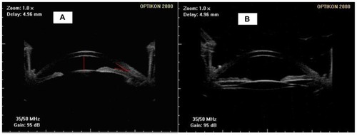 Figure 1 Ultrasonic biomicroscopic images for the same eye before (A) and one month after surgery (B) showing increased anterior chamber depth and an enlarged iridocorneal angle.