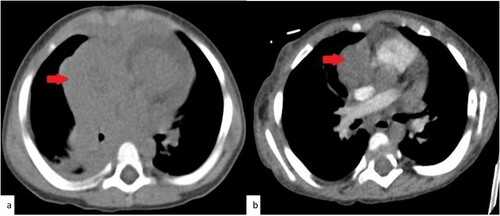 Figure 2. CT chestPre and post Induction. Selected axial images from the CT scan of the chest. (a)Trans-axial image from the non-enhanced CT scan of the chest at the time of diagnosis demonstrates the large right mediastinal soft tissue mass at the level of the heart. (b) trans-axial image from the contrast enhanced CT scan of the chest after the induction demonstrate the mediastinal mass with significant reduction in size.