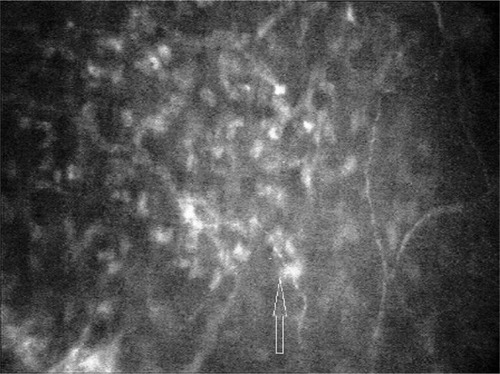 Figure 2 Stromal keratocyte nuclei (arrow) and nerve fibers observed in Bowman’s plane of the right eye in stage 3 keratoconus. Magnification 500× with 40× objective lens.