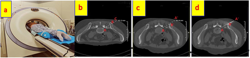 Figure 3 The vertical CT scanning was used to locate the plane of the L5-S1 intervertebral space and confirm A, B, C points (b). The CT tilted angle to make the puncture path without obstruction (a and c), Find the puncture point A’ on the skin, and the plasma puncture probe through A’ point slowly reached the A guided by tilt CT scans (d).