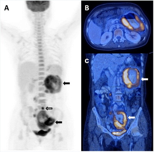 Figure 1. Patient 4, showing primary small bowel involvement. (A) Markedly hypermetabolic disease involving segments of the jejunum and ileum (arrows) without evidence of FDG-avidity in the remaining small bowel to suggest co-existing enteropathy. There were also hypermetabolic nodal disease (open arrow). (B) Axial image showing markedly hypermetabolic thickened and dilated jejunal loop in the upper abdomen. (C) Coronal image showing hypermetabolic diseased jejunal and ileal loops (arrows).