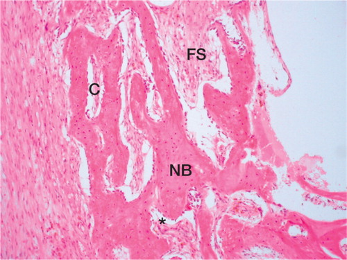 Figure 2. Typical histological section from a sample of a graft from a goat that received ketoprofen (hematoxylin and eosin). Newly formed woven bone (NB) in a fibrovas-cular stroma (FS) can be seen, with vital osteoblasts (*) and osteoclasts (C) surrounding the newly formed bone. Magnification 50x.