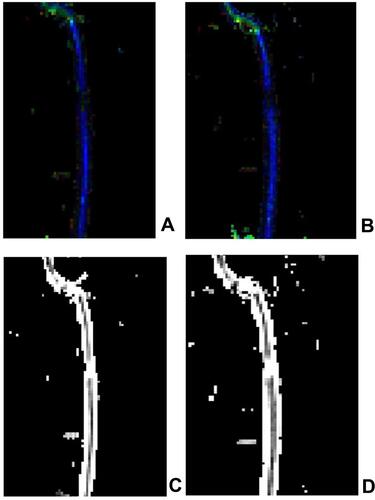 Figure 5 The FA image and the ADC image in a patient with incomplete thoracic SCI (A) FA image before the treatment; (B) FA image after the treatment; some green or red abnormal signal opacities could be observed in the blue spinal cord without interruption of the blue spinal cord. (C) ADC image before the treatment; (D) ADC image after the treatment. A partially increased signal and light gray or white changes without an interruption signal could be observed in the ADC image.