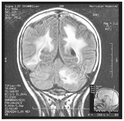 Figure 1 Magnetic resonance imaging scan showing multifocal white matter lesions in both subcortical cerebral hemispheres and left cerebellar regions without any mass effect or surrounding edema.