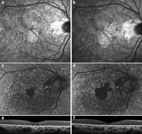 Figure 3. Evolution of macular findings in a single patient with RCBTB1-associated retinal dystrophy.