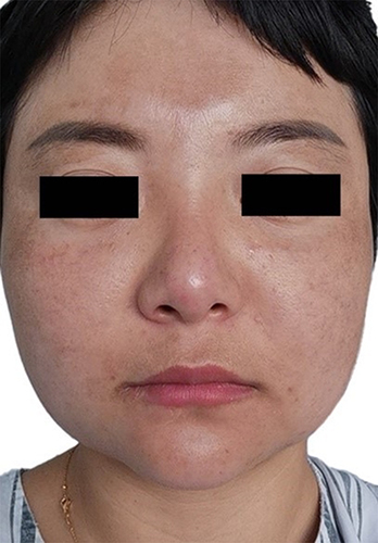 Figure 3 Photograph of the patient after 17 days of treatment in hospital with minocycline (50mg/night), 0.03% tacrolimus cream, CG (40mL /d infusion), vitamin C (10mL/d infusion) and local microwave physiotherapy.