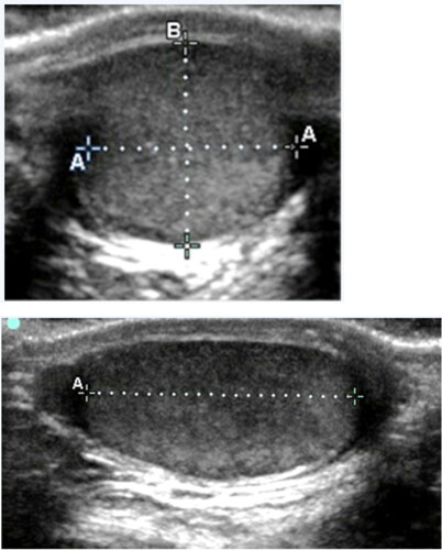 Figure 2. The ultrasound determined testicular volume (TV). Measurements of width and depth (above). Measurement of length (below).