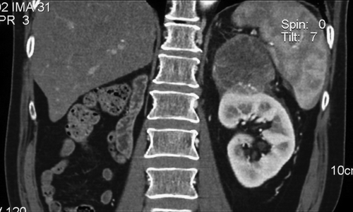 Figure 1.  Abdominal CT scan revealing a large left adrenal mass in the absence of the right adrenal.