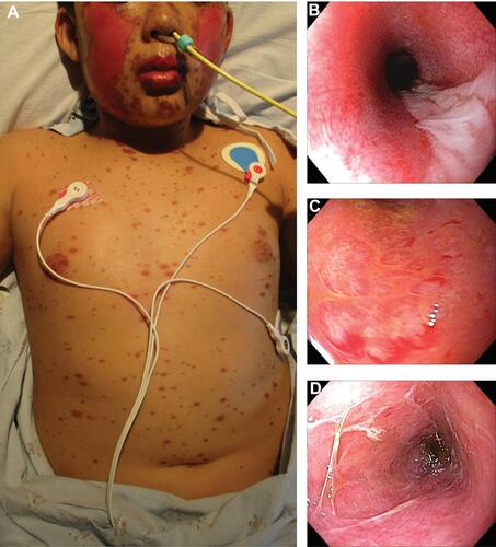 Figure 1 Classic erythematous papules of Stevens-Johnson syndrome present on the trunk and face with sloughing of the epidermis on the cheeks (A). Upper endoscopy images of the esophagus (B), duodenum (C), and flexible sigmoidoscopy image of the colon (D) demonstrate severe concomitant gastrointestinal involvement.
