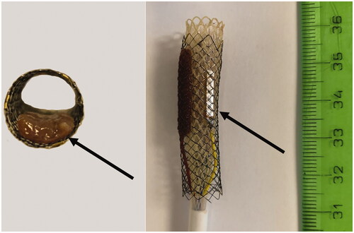 Figure 3. Model of metal stent with partial occlusion: Left – axial view of the metal stent with inserted band liver tissue (arrow). Right – tubular IRE catheter inside the metal stent with an inserted band of liver tissue between the stent and active IRE electrode (not visible), the other active electrode is in contact with the metal stent (visible arrow) (Scenario B).