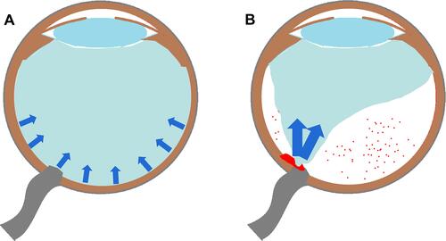 Figure 6 Illumination of vitreous traction with/without vitreous detachment. (A) Vitreous traction is uniform and dispersed (small blue arrows) when there is no vitreous detachment; (B) vitreous traction is concentrated and strengthened to the nasal optic disc (big blue arrows) with incomplete vitreous detachment sparing the optic disc, causing various types of bleeding (red spots and plaque).