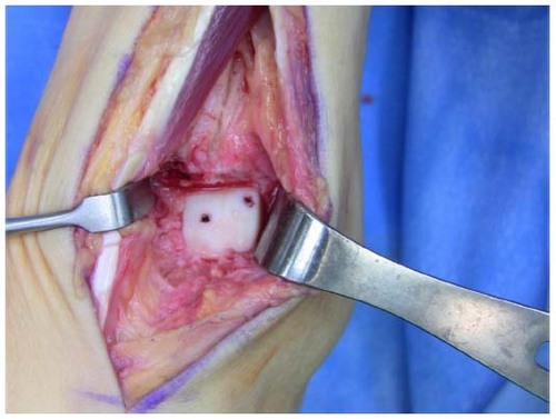 Figure 5 Implantation of fresh osteochondral lateral hemitalus allograft with headless screw fixation through an anterior approach.