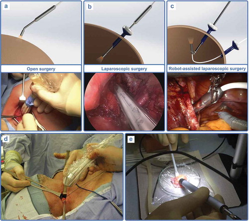 Figure 1. 1D nuclear detection probes. (a) Open surgery low-to-mid energy gamma probe, with example during ROLL procedure with ICG-99mTc-nanocolloid for recurrent melanoma (from [Citation219]). (b) Laparoscopic surgery low-to-mid energy gamma probe, with example during SN procedure with ICG-99mTc-nanocolloid for prostate cancer. (c) DROP-IN gamma probe for robot-assisted laparoscopic surgery, for example, during lymphatic salvage procedures in recurrent prostate cancer using 99mTc-PSMA. (d) High energy gamma probe for open surgery, with example in head and neck squamous cell carcinoma showing 18F-FDG avid lymph node with metastases (from [Citation127]). (e) Open surgery beta- probe, with example of ex vivo tumor with 90Y-DOTATOC in meningioma (from [Citation144]).