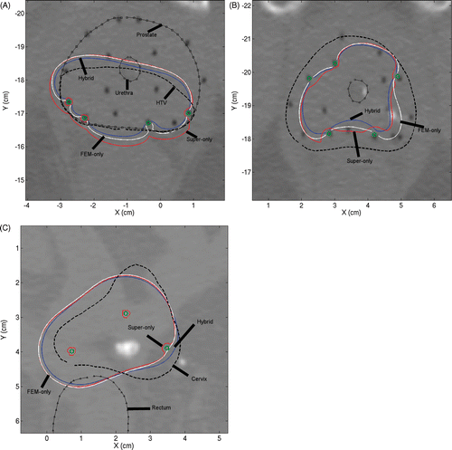 Figure 9. Axial slice views of posterior peripheral (A) and peripheral (B) implants in prostate and peripheral implant (C) in cervix. The first two examples employed 180° applicators and the third 360° applicators. 41°C contours obtained by superposition/FEM hybrid plan (blue), FEM-only plan (white) and superposition-only plan (red) can be seen.