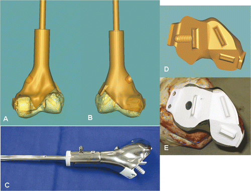 Figure 8. A CAD custom joint-saving prosthesis of the distal femur (C) was designed and manufactured based on the exact dimensions of the bone defect created in the virtual tumor resection. Posterior (A) and anterior (B) views of the 3D CAD model of the planned reconstruction are shown. With the help of this model, surgeons and implant engineers could discuss more effectively the choice of fixation at the distal prosthetic junction (length/direction of screws and extracortical plates). The CAD design and the actual prosthesis at the distal junction are shown in (D) and (E), respectively. The cutting flutes provided additional stability for fixation, and a coating of hydroxyapatite (white) was used to facilitate osteointegration at the proximal and distal prosthetic junctions.