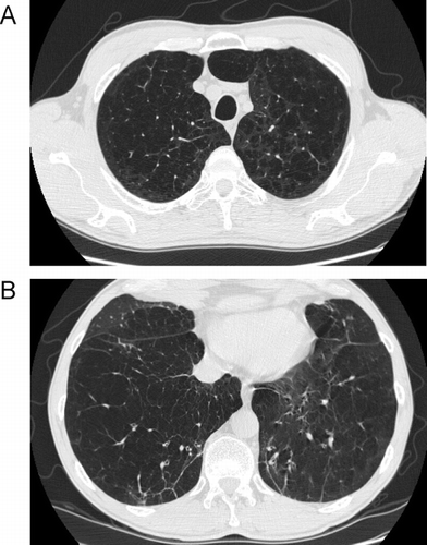 Figure 14 Comparison of centrilobular to panlobular emphysema. (A) the scan through the upper lobes shows some areas of centrilobular emphysema, but there are also some larger areas of decreased attenuation indicating confluent panlobular emphysema. (B) a scan through the lower lobes (same patient as A) shows larger areas of confluent panlobular emphysema.