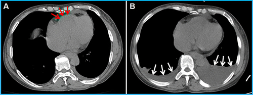 Figure 5 Computerized tomography (CT) manifestation of Loeffler endocarditis. (A) Ventricular mass composed of thrombus and endomyocardial fibrosis (red arrow); (B) Loeffler endocarditis with bilateral pleural effusion (white arrow).
